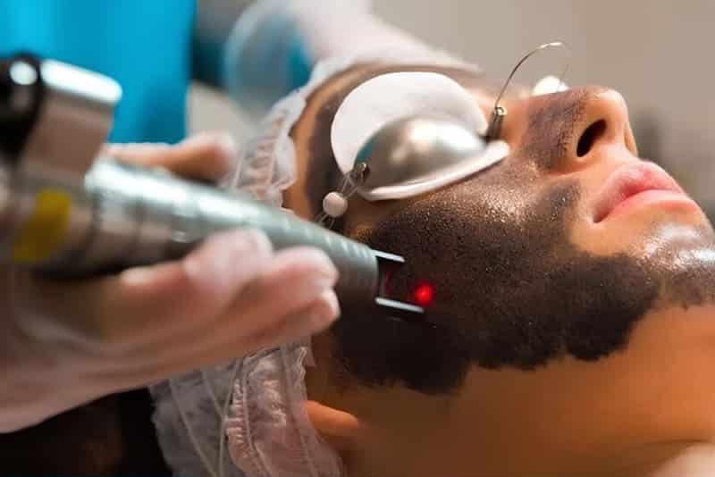 Transformação Instantânea: Os Benefícios do Peeling de Hollywood